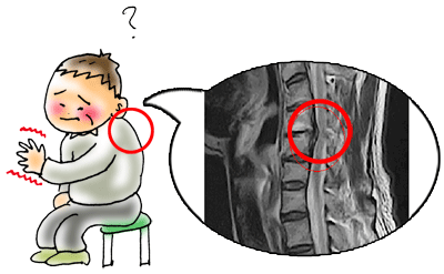 靭帯骨化により脊髄が圧迫されています