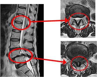 脊柱管が狭くなり、脊髄を圧迫しやすい状態になっています。